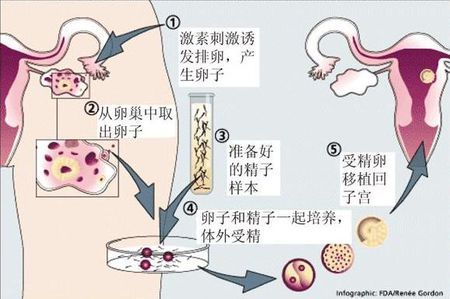 单身试管供卵服务公司